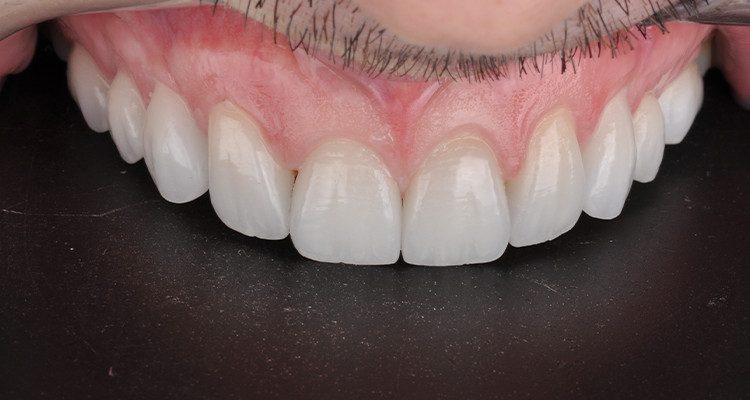 Caso 18 15 - Laminados Cerâmicos para Reabilitação Estética 13 | Foto intraoral final.