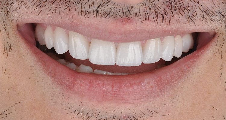 Caso 18 16 - Laminados Cerâmicos para Reabilitação Estética 14 | Aspecto final do sorriso.