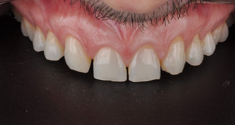 Caso 18 2 - Laminados Cerâmicos para Reabilitação Estética 1B | Aspecto inicial intraoral.