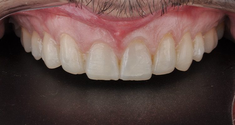 Caso 18 3 - Laminados Cerâmicos para Reabilitação Estética 2 | Planejamento estético com Primmaart, na cor A2 – mockup.