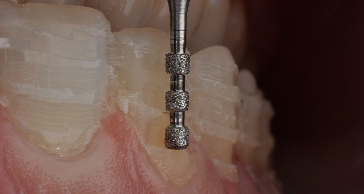 Caso 18 4 - Laminados Cerâmicos para Reabilitação Estética 3 | Guias de orientação – preparo sobre mockup.