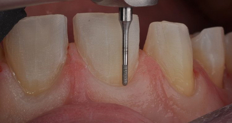 Caso 18 5 - Laminados Cerâmicos para Reabilitação Estética 4 | Término com brocas para micropreparos.