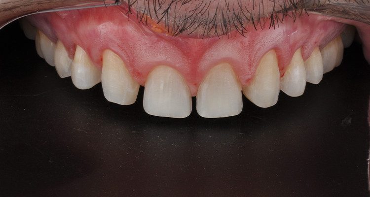 Caso 18 6 - Laminados Cerâmicos para Reabilitação Estética 5 | Aspecto dos dentes após o preparo sobre mockup.