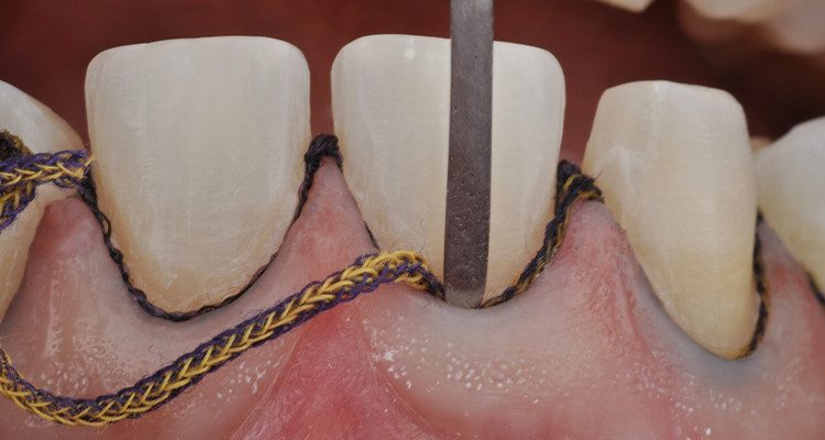 Caso 18 7 - Laminados Cerâmicos para Reabilitação Estética 6 | Inserção do fio de afastamento gengival.