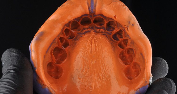 Caso 18 8 - Laminados Cerâmicos para Reabilitação Estética 7 | Moldagem superior em silicone de adição Silic-One.