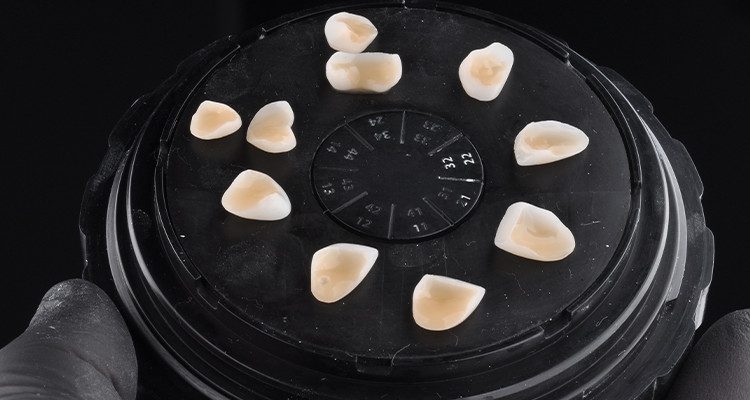 Caso 18 9 - Laminados Cerâmicos para Reabilitação Estética 8 | Condicionamento com Condac Porcelana 5%.