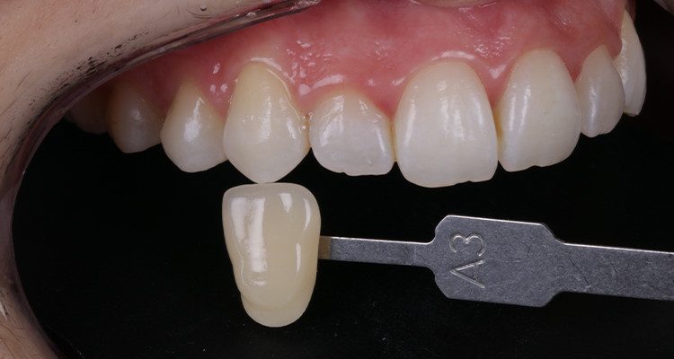 10 | Foto intrabucal lateral após 35 dias do clareamento, comparando com a escala de cores VITA que foi selecionada no início do caso – A3 canino