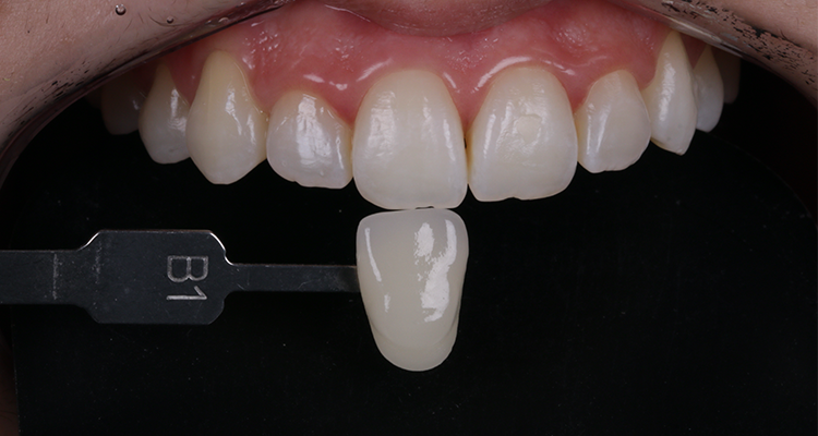 11 | Foto intrabucal frontal comparando com a escala de cores VIT A, compatível com a cor final obtida após o clareamento – B1 incisivo.