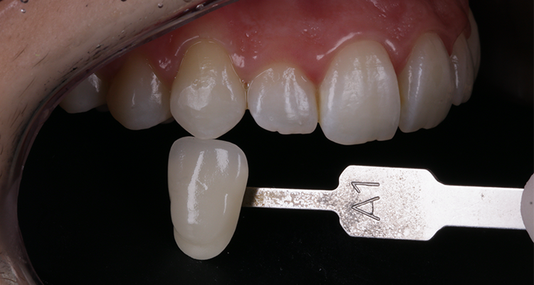 12 | Foto intrabucal lateral comparando com a escala de cores VIT A, compatível com a cor final obtida após o clareamento – A1 canino.