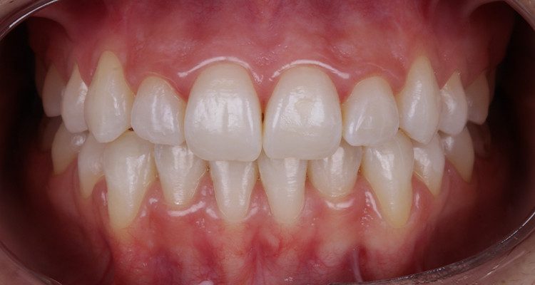 13 | Foto intrabucal frontal final.