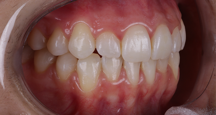 14 | Foto intrabucal, lateral esquerda final