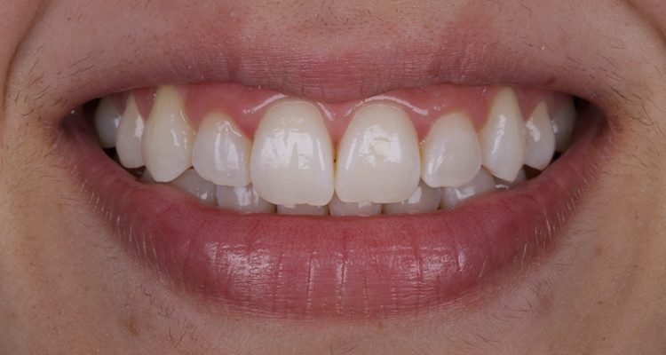 15 | Aspecto final do clareamento caseiro