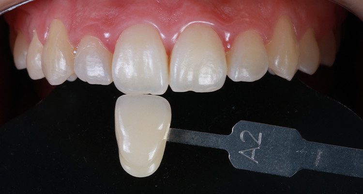 2 | Foto intrabucal comparando escala de cores VITA – Incisivo A2, correspondendo a cor inicial do caso