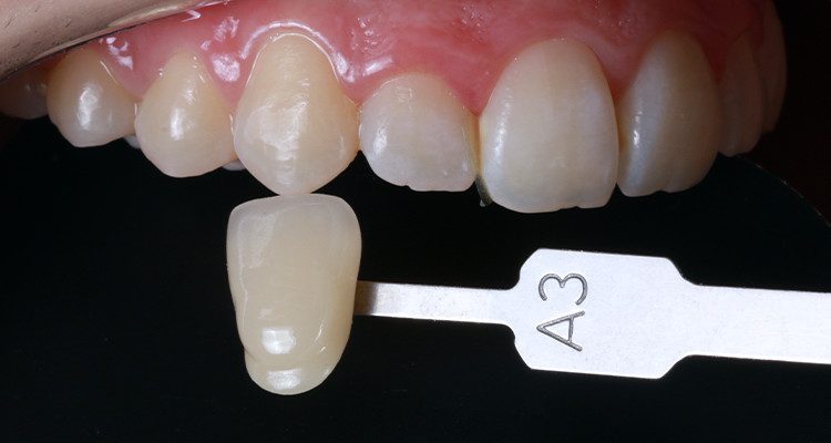 3 | Foto intrabucal comparando escala de cores VITA – canino A3, correspondendo a cor inicial do caso.