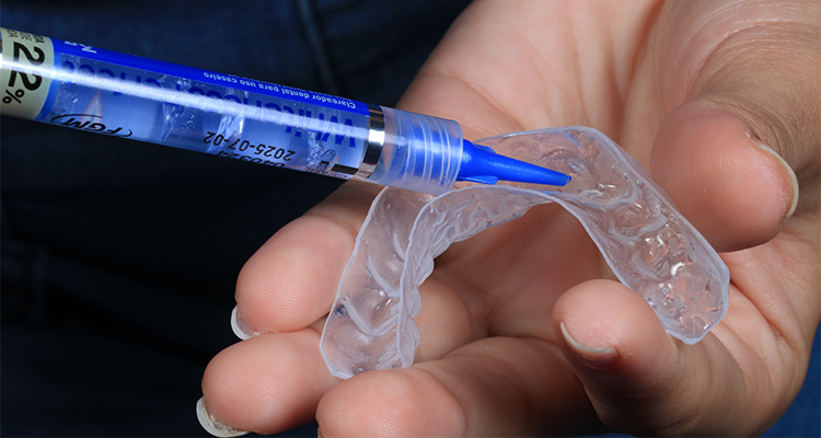 4 | Aplicação do gel clareador na moldeira
