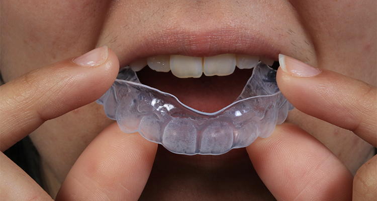 6 | Adaptação da moldeira superior.