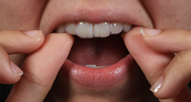 7 | Moldeira superior adaptada.