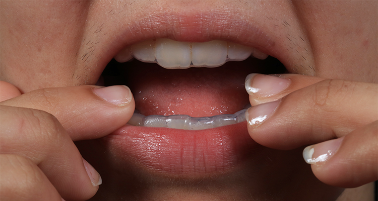 8 | Moldeira inferior adaptada.