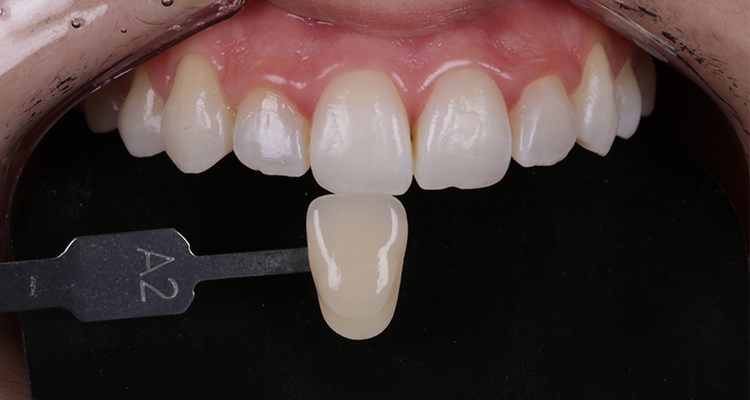 9 | Foto intrabucal frontal após 35 dias do clareamento, comparando com a escala de cores VITA que foi selecionada no início do caso – A2 incisivo