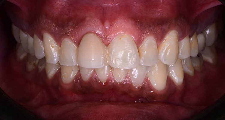 Caso 21 1 - Restauração estética com pino de fibra de vidro e resina composta 1 | Imagem intraoral do sorriso em oclusão