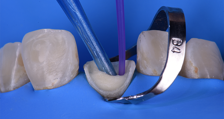 Caso 21 10 - Restauração estética com pino de fibra de vidro e resina composta 10 | Irrigação final com água destilada.