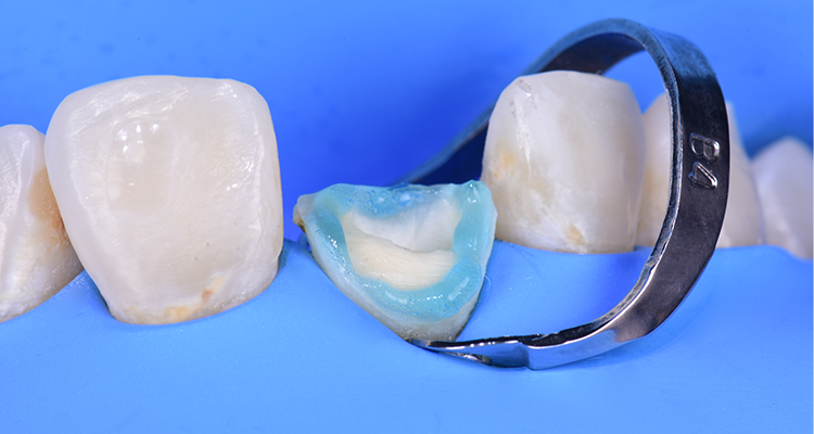 Caso 21 11 - Restauração estética com pino de fibra de vidro e resina composta 11 | Condicionamento com ácido fosfórico Condac 37% por 30 segundos em esmalte.