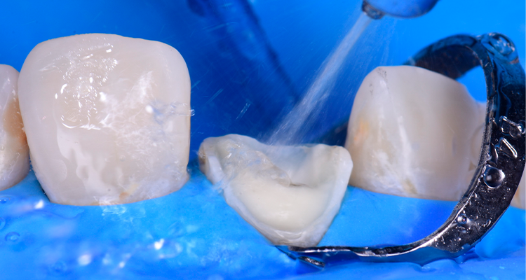 Caso 21 12 - Restauração estética com pino de fibra de vidro e resina composta 12 | Remoção do ácido fosfórico com jato de ar e água durante 30 segundos.