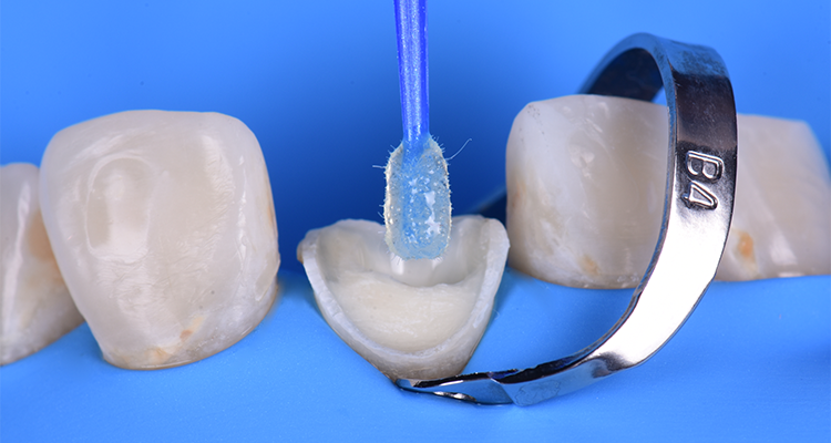 Caso 21 14 - Restauração estética com pino de fibra de vidro e resina composta 14 | Aplicação do sistema adesivo Ambar Universal APS, de forma ativa por 20 segundos na porção coronária e no interior do conduto.