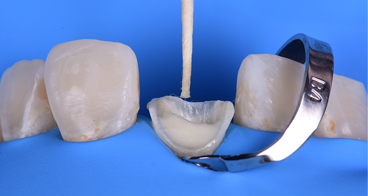 Caso 21 15 - Restauração estética com pino de fibra de vidro e resina composta 15 | Remoção do excesso de adesivo depositado no fundo do canal radicular com cone de papel absorvente, preservando a camada adesiva das paredes radiculares.