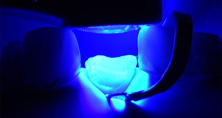 Caso 21 16 - Restauração estética com pino de fibra de vidro e resina composta 16 | Fotoativação do sistema adesivo por 40 segundos.