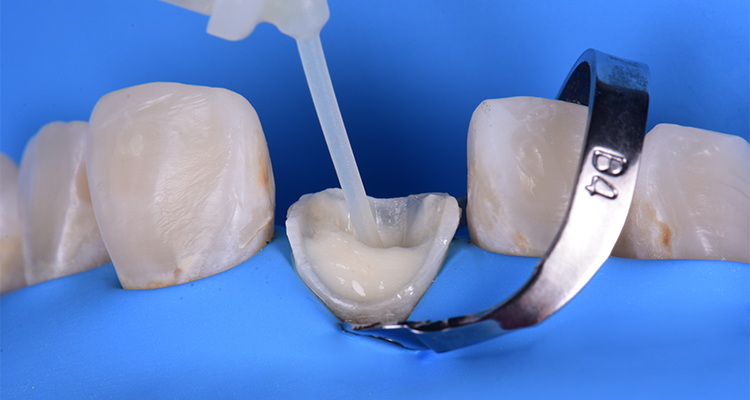 Caso 21 18 - Restauração estética com pino de fibra de vidro e resina composta 18 A e B | Inserção do cimento resinoso dual core Allcem Core no interior do canal radicular, posicionamento a ponteira o mais apicalmente possível (A). Remoção lenta da ponteira à medida que o cimento é injetado lentamente para evitar bolhas (B)