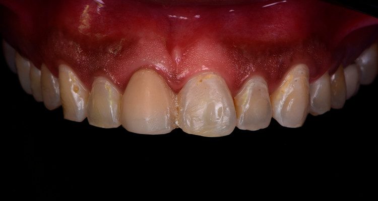 Caso 21 2 - Restauração estética com pino de fibra de vidro e resina composta 2 | Imagem intraoral frontal da arcada superior.