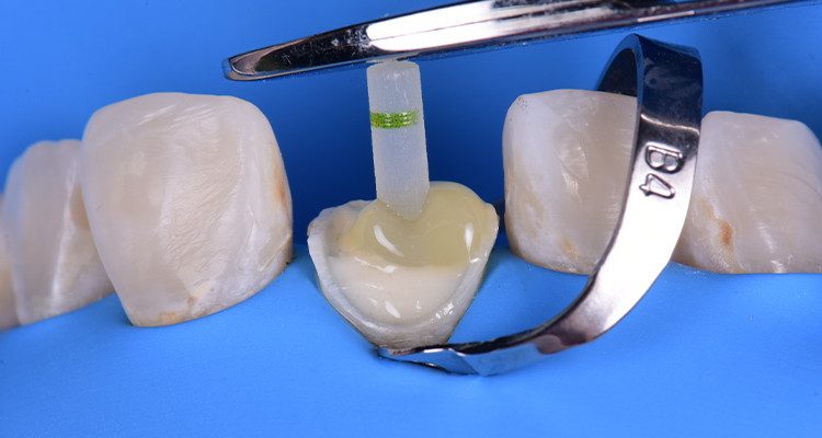 Caso 21 20 - Restauração estética com pino de fibra de vidro e resina composta 19 | Aguardar durante 5 minutos para presa química do cimento Allcem Core.