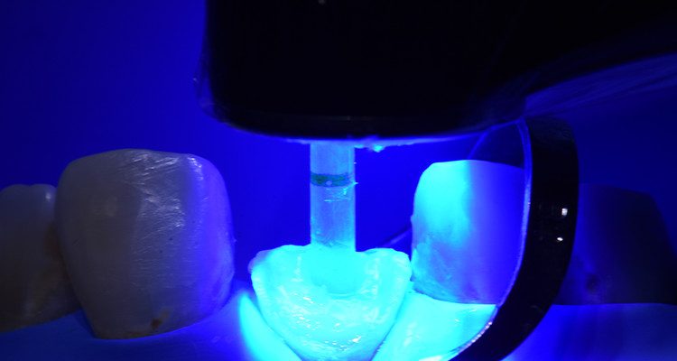 Caso 21 21 - Restauração estética com pino de fibra de vidro e resina composta 20 | Fotoativação por 40 segundos usando fonte de luz com boa potência/irradiância pela face incisal, seguido pela vestibular e palatina do pino de fibra de vidro