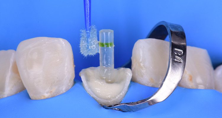 Caso 21 22 - Restauração estética com pino de fibra de vidro e resina composta 21 | Aplicação do sistema adesivo Ambar Universal APS no pino de fibra de vidro.