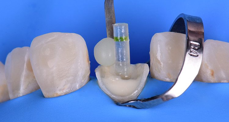 Caso 21 23 - Restauração estética com pino de fibra de vidro e resina composta 22 | Inserção de resina composta Vittra APS.