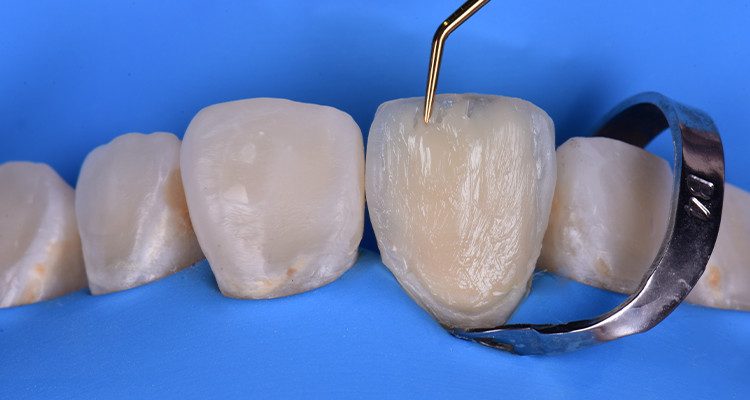 Caso 21 26 - Restauração estética com pino de fibra de vidro e resina composta 25 A e B
A. Confecção dos mamelos; B. Aspecto final da camada de dentina.