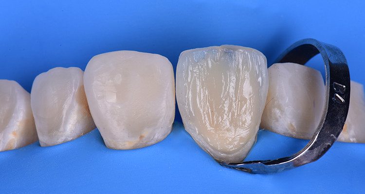 Caso 21 27 - Restauração estética com pino de fibra de vidro e resina composta 25 A e B
A. Confecção dos mamelos; B. Aspecto final da camada de dentina.