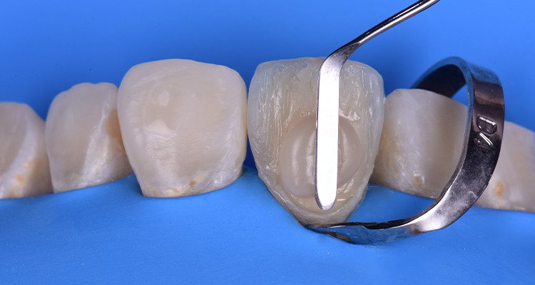 Caso 21 28 - Restauração estética com pino de fibra de vidro e resina composta 26 | Construção da camada de esmalte, com resina Vittra APS, na cor EA2.