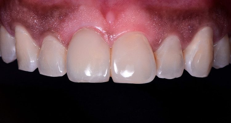 Caso 21 29 - Restauração estética com pino de fibra de vidro e resina composta 27 | Aspecto final do dente 11 e 21 após acabamento e polimento