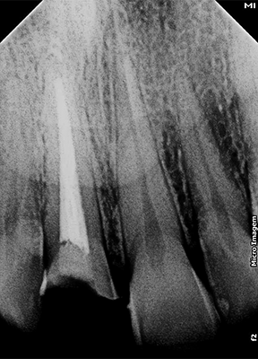 Caso 21 3 - Restauração estética com pino de fibra de vidro e resina composta 3 | Radiografia Inicial do dente 11 demonstrando adequado tratamento endodôntico e selamento com cimento de ionômero de vidro