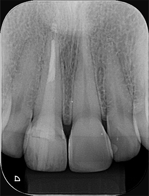 Caso 21 30 - Restauração estética com pino de fibra de vidro e resina composta 28 | Radiografia final do dente 11.