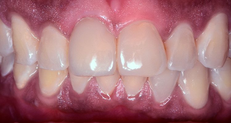 Caso 21 31 - Restauração estética com pino de fibra de vidro e resina composta 29 | Aspecto final mostrando uma harmonia de forma e cor dos dentes 11 e 21 com os demais dentes.