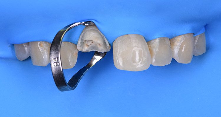 Caso 21 4 - Restauração estética com pino de fibra de vidro e resina composta 4 | Arco superior isolado de forma absoluta com auxílio do grampo B4, observando a pouca estrutura remanescente e consequentemente a necessidade de se utilizar pino de fibra de vidro.