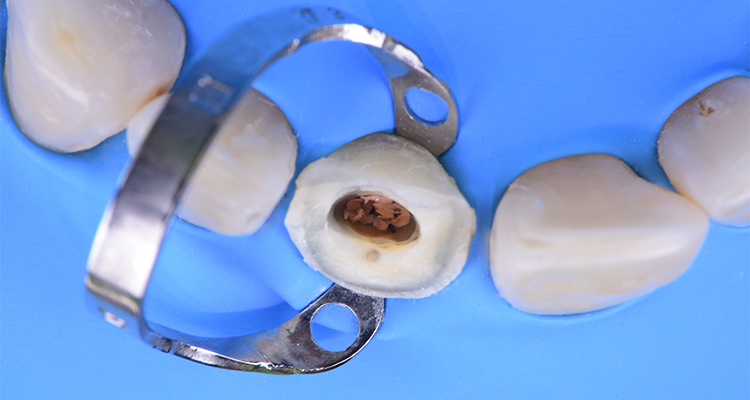 Caso 21 5 - Restauração estética com pino de fibra de vidro e resina composta 5 | Vista oclusal do preparo.