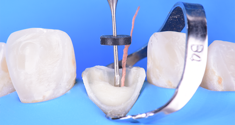 Caso 21 6 - Restauração estética com pino de fibra de vidro e resina composta 6 | Remoção da guta-percha, deixando de 3 a 4 mm na região apical.