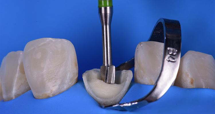 Caso 21 7 - Restauração estética com pino de fibra de vidro e resina composta 7 | Preparo do conduto radicular com broca específica do sistema de pinos Whitepost System DC-E 2