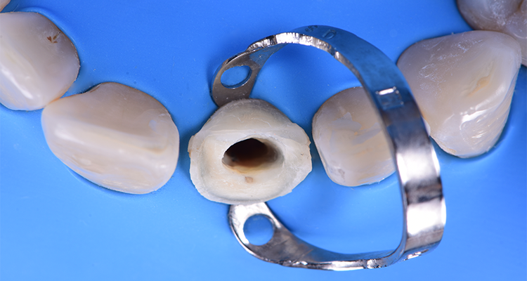 Caso 21 8 - Restauração estética com pino de fibra de vidro e resina composta 8 | Vista oclusal após preparo do conduto.