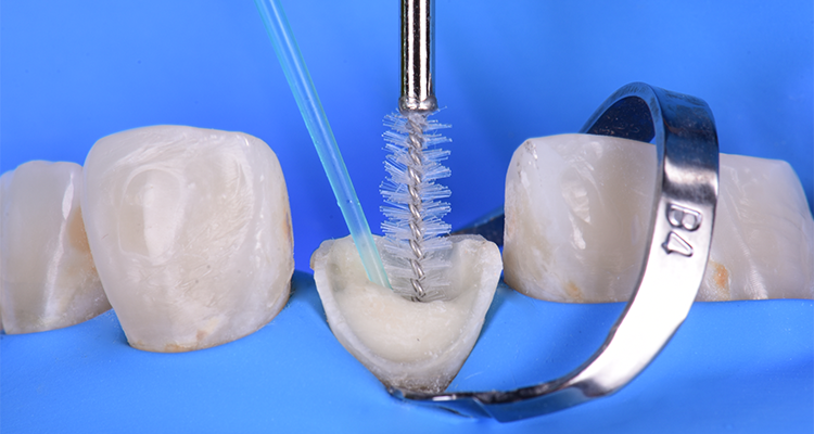 Caso 21 9 - Restauração estética com pino de fibra de vidro e resina composta 9 | Aplicação de solução irrigadora EDTA a 17% três minutos no conduto radicular e instrumentação ativa de solução irrigadora com escova para conduto.