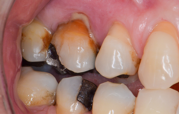 Caso 23 1 - Implante imediato e cicatrizador personalizado para manutenção do contorno tecidual em região molar 1 | Aspecto inicial do dente 16. Destaque para a supuração drenada via sulco gengival